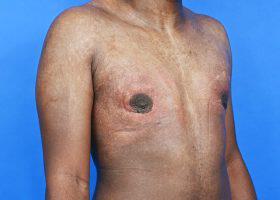 Gynecomastia Surgery Before & After Image