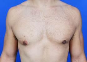 Gynecomastia Surgery Before & After Image
