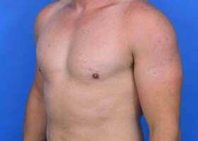 Gynecomastia Surgery Before & After Image