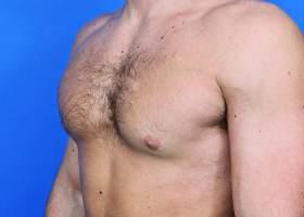 Gynecomastia Surgery Before & After Image