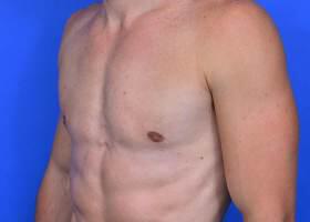 Gynecomastia Surgery Before & After Image