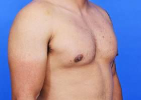 Gynecomastia Surgery Before & After Image