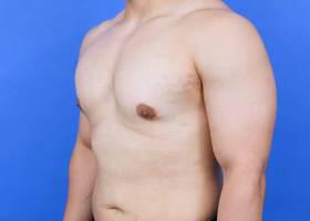 Gynecomastia Surgery Before & After Image