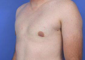 Gynecomastia Surgery Before & After Image