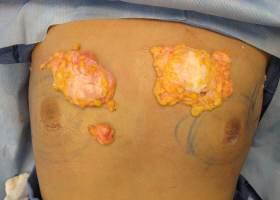 Gynecomastia Surgery Before & After Image