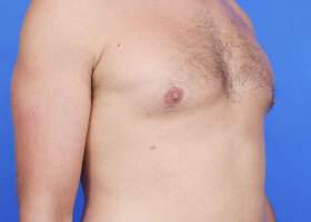 Gynecomastia Surgery Before & After Image