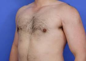 Gynecomastia Surgery Before & After Image
