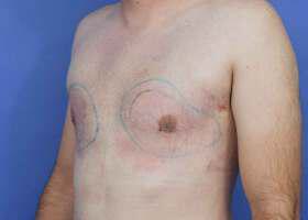 Gynecomastia Surgery Before & After Image