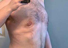 Gynecomastia Surgery Before & After Image