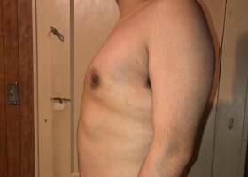 Gynecomastia Surgery Before & After Image