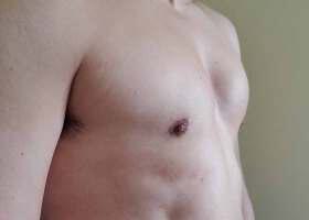 Gynecomastia Surgery Before & After Image