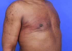 Gynecomastia Surgery Before & After Image