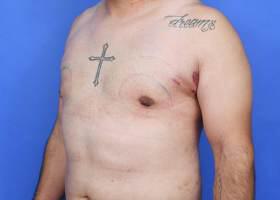 Gynecomastia Surgery Before & After Image