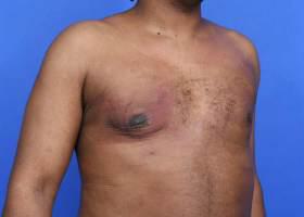Gynecomastia Surgery Before & After Image