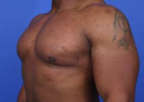 Gynecomastia Surgery Before & After Image