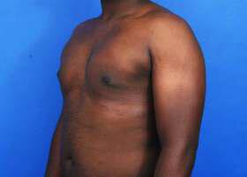 Gynecomastia Surgery Before & After Image