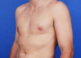 Gynecomastia Surgery Before & After Image
