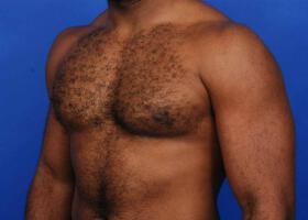 Gynecomastia Surgery Before & After Image