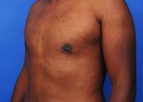 Gynecomastia Surgery Before & After Image
