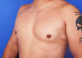 Gynecomastia Surgery Before & After Image