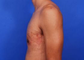 Gynecomastia Surgery Before & After Image