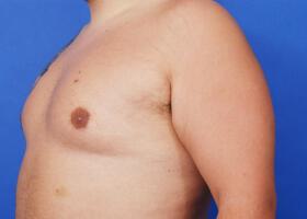 Gynecomastia Surgery Before & After Image