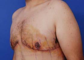 Gynecomastia Surgery Before & After Image