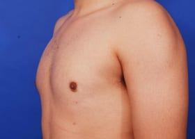 Gynecomastia Surgery Before & After Image