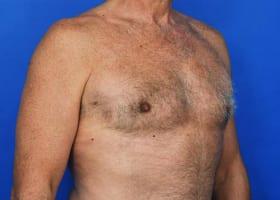 Gynecomastia Surgery Before & After Image