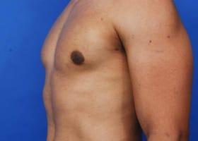 Gynecomastia Surgery Before & After Image