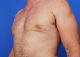 Gynecomastia Surgery Before & After Image