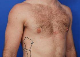 Gynecomastia Surgery Before & After Image