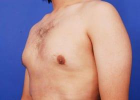 Gynecomastia Surgery Before & After Image