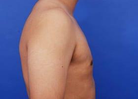 Gynecomastia Surgery Before & After Image