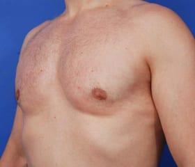Gynecomastia Surgery Before & After Image