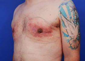 Gynecomastia Surgery Before & After Image