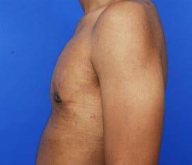 Gynecomastia Surgery Before & After Image