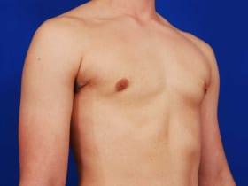 Gynecomastia Surgery Before & After Image