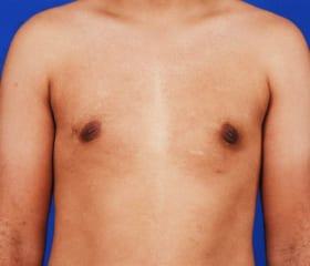 Gynecomastia Surgery Before & After Image