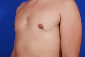 Gynecomastia Surgery Before & After Image