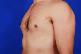 Gynecomastia Surgery Before & After Image