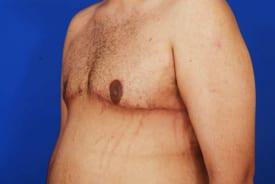 Gynecomastia Surgery Before & After Image