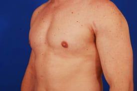 Gynecomastia Surgery Before & After Image