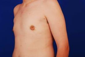 Gynecomastia Surgery Before & After Image