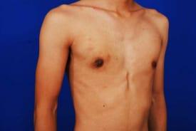 Gynecomastia Surgery Before & After Image