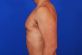 Gynecomastia Surgery Before & After Image