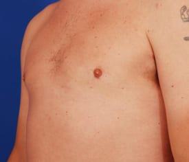 Gynecomastia Surgery Before & After Image