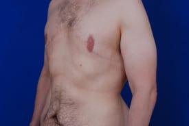 Gynecomastia Surgery Before & After Image