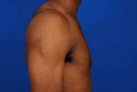 Gynecomastia Surgery Before & After Image