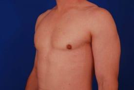 Gynecomastia Surgery Before & After Image